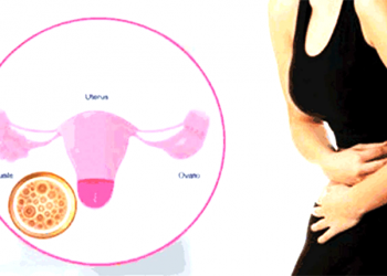 पाठेघरसम्बन्धी रोगले समस्याग्रस्त ३२ जना महिलामध्ये १९ जनाको निःशुल्क शल्यक्रिया