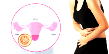 पाठेघरसम्बन्धी रोगले समस्याग्रस्त ३२ जना महिलामध्ये १९ जनाको निःशुल्क शल्यक्रिया